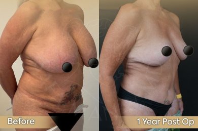 Vorher-nachher-Ergebnis Bruststraffung bei Dr. Safa Manav Clinic, 1 Jahr postoperativ