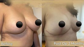 Vorher-nachher-Ergebnis Bruststraffung bei Dr. Safa Manav Clinic, verbesserte Brustform