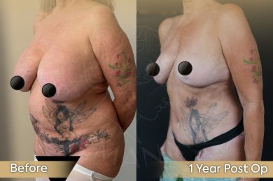 Bruststraffung Vorher-Nachher-Ergebnis bei Dr. Safa Manav Clinic, verbesserte Kontur