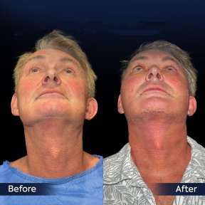 Vorher-nachher-Ergebnis des Facial Fat Transfer in der Dr. Safa Manav Klinik, verbesserte Kieferlinie