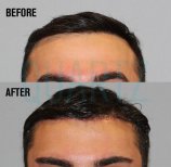 Résultats lifting du front avant/après à Quartz Hospital – front lissé et relevé