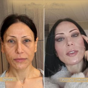 Vorher-nachher-Ergebnis Gesichts-Fetttransfer bei Dr. Safa Manav, 3 Monate post-op