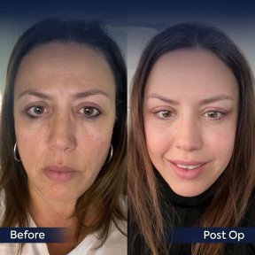 Vorher-nachher-Ergebnis des Facial Fat Transfer in der Dr. Safa Manav Klinik, verjüngtes Aussehen