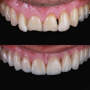 نتائج قبل وبعد عدسات الأسنان الخزفية في RO Dental Clinic – تحسين مظهر الابتسامة