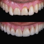 نتائج قبل وبعد عدسات الأسنان الخزفية في RO Dental Clinic – تحسين مظهر الابتسامة