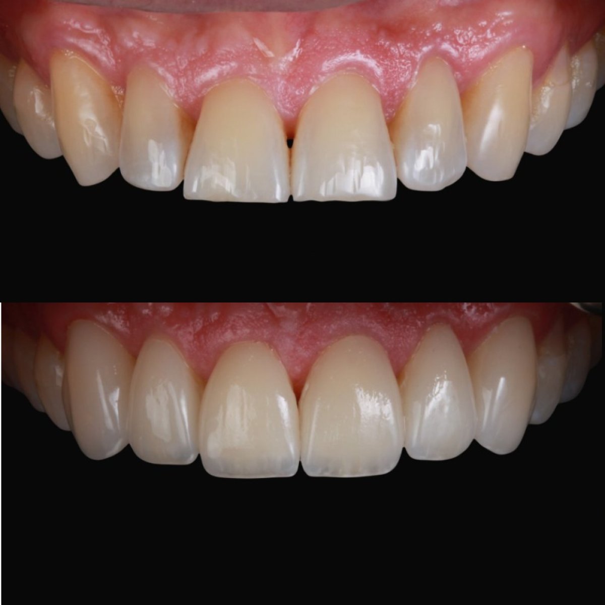 Resultados antes y después de carillas de porcelana en RO Dental Clinic – sonrisa mejorada