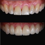 Foto sebelum dan sesudah Veneer Porselen oleh Dr. 