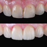 Foto sebelum dan sesudah Veneer Porselen oleh Dr. 