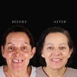 До и после установки зубного моста в RO Dental Clinic, результат восстановления улыбки