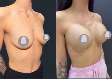 Before and after breast implants with lift at Dr. MED – enhanced breast shape and volume result