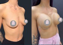 Before and after breast implants with lift at Dr. MED – enhanced breast shape and volume result