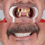 Zdjęcia przed i po Implantacja zębów wykonane przez dr. 