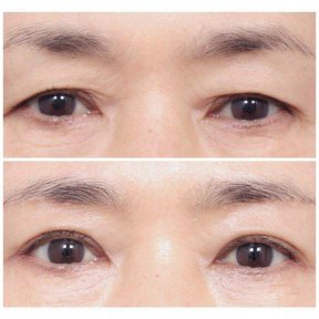 Before and after blepharoplasty results at AB PLASTIC SURGERY, eyelid correction improvement