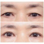 Before and after blepharoplasty results at AB PLASTIC SURGERY, eyelid correction improvement