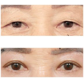 Vorher-nachher-Ergebnis der Blepharoplastik bei AB PLASTIC SURGERY, Lidkorrektur