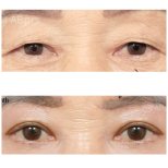 Vorher-nachher-Ergebnis der Blepharoplastik bei AB PLASTIC SURGERY, Lidkorrektur