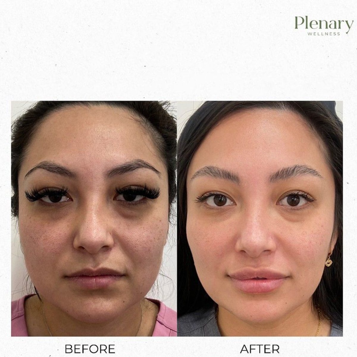 Resultados faciales antes y después de terapia PRP en Plenary Wellness, piel mejorada