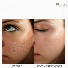 Before and after PRP therapy for acne scars at Plenary Wellness, visible skin texture improvement