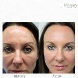 Fotos de antes y después de Terapia de Plasma Rico en Plaquetas (PRP) tomadas por el Dr.(la Dra.) 