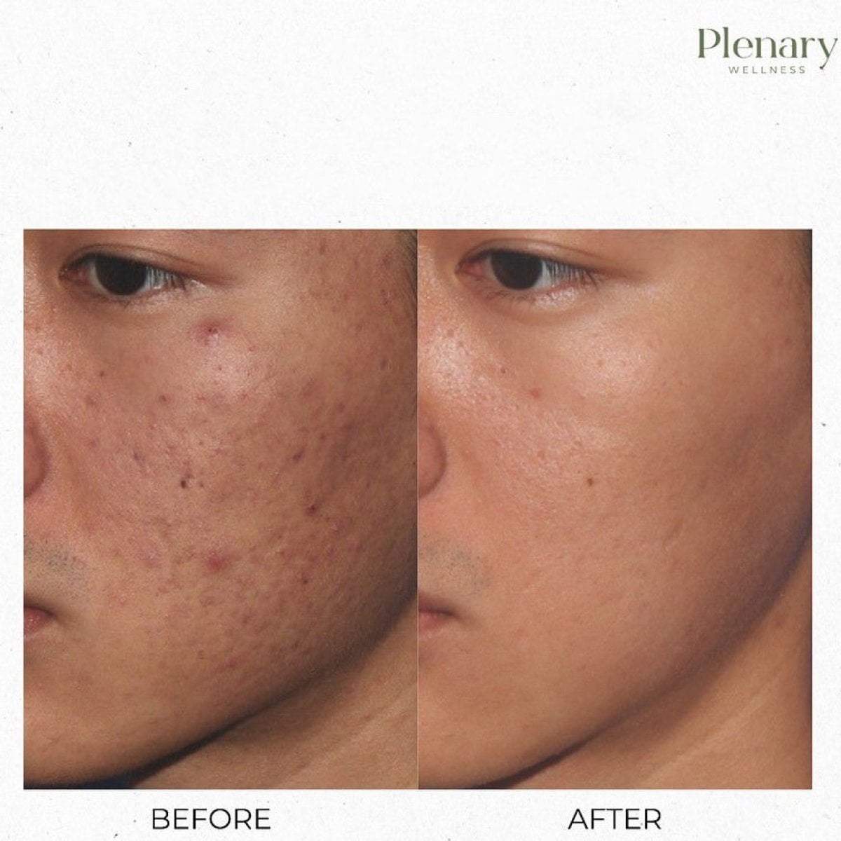 نتائج علاج PRP لندبات حب الشباب في Plenary Wellness، تحسن ملمس البشرة