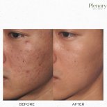 Fotos de antes y después de Terapia de Plasma Rico en Plaquetas (PRP) tomadas por el Dr.(la Dra.) 