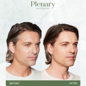 Результат до і після ін'єкцій філерів у Plenary Wellness, помітне омолодження обличчя