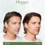 Результат до і після ін'єкцій філерів у Plenary Wellness, помітне омолодження обличчя