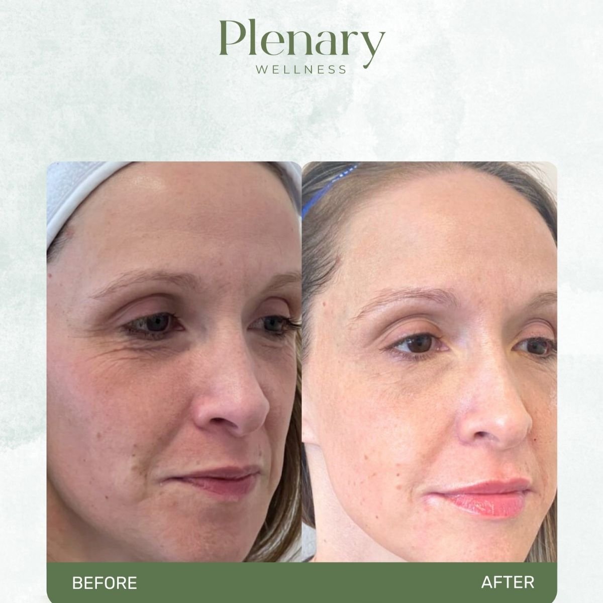 نتائج قبل وبعد حقن الفيلر في Plenary Wellness، تجديد شباب الوجه بشكل واضح