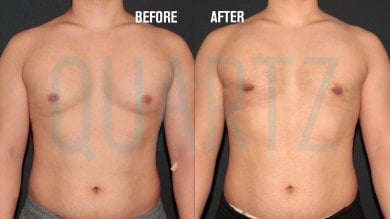Gynecomastia surgery before and after results at Quartz Hospital – flatter male chest contour