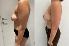 Vorher-nachher-Ergebnis Bruststraffung mit runden Implantaten, verbesserte Brustform