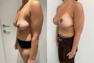 Vorher-nachher-Ergebnis Bruststraffung mit runden Implantaten, verbesserte Form und Volumen