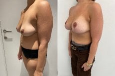 Vorher-nachher-Ergebnis Bruststraffung mit runden Implantaten, verbesserte Form und Volumen