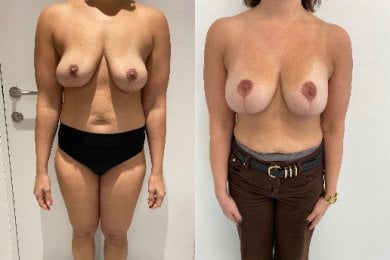 Vorher-nachher-Ergebnis Bruststraffung mit runden Implantaten – verbesserte Form und Volumen