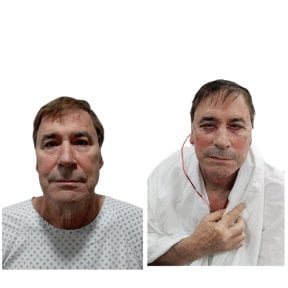 Before and after facelift results at Hospital de la Familia, visible facial rejuvenation