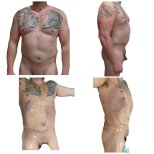 Before and after liposuction results at Hospital de la Familia, improved male body contour