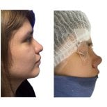 Fotos de antes y después de Rinoplastia tomadas por el Dr.(la Dra.)