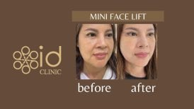 Foto sebelum dan sesudah Mini Facelift oleh Dr.