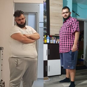 نتائج قبل وبعد جراحة تحويل مسار المعدة في Assoc.Prof.Dr.Cemal Kara / Medical Park İzmir Hospital