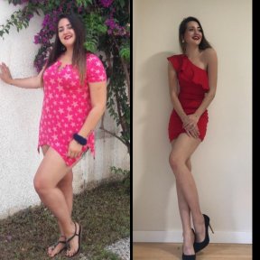 نتائج قبل وبعد جراحة تحويل مسار المعدة في Assoc.Prof.Dr.Cemal Kara / Medical Park İzmir Hospital