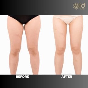 Before and after thigh lift results at ID Clinic Bangkok, improved leg contour and skin tightening