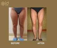 Before and after thigh lift results at ID Clinic Bangkok, improved leg contour and firmness