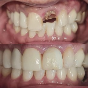 Vorher-nachher-Ergebnis Zahnimplantat mit Abutment bei SoftDentalCare Clinic, wiederhergestelltes Lächeln