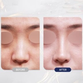 Результаты ринопластики до и после в VG Plastic Surgery, улучшенная форма носа