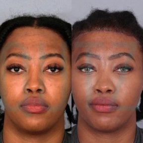 Результати підтяжки чола до і після в Quartz Hospital, помітне підняття брів