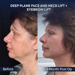 Résultats lifting visage et cou avant/après à la clinique Dr. Safa Manav, 5 mois post-op