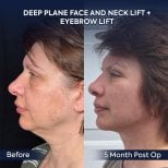 Résultats lifting visage et cou avant/après à la clinique Dr. Safa Manav, 5 mois post-op