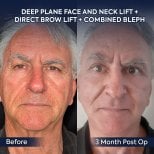 Résultats avant/après lifting visage, cou, sourcils, blépharoplastie à la clinique Dr. Safa Manav