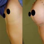 Before and after buttock augmentation at Private Yüzyıl Hospital, visible volume enhancement result