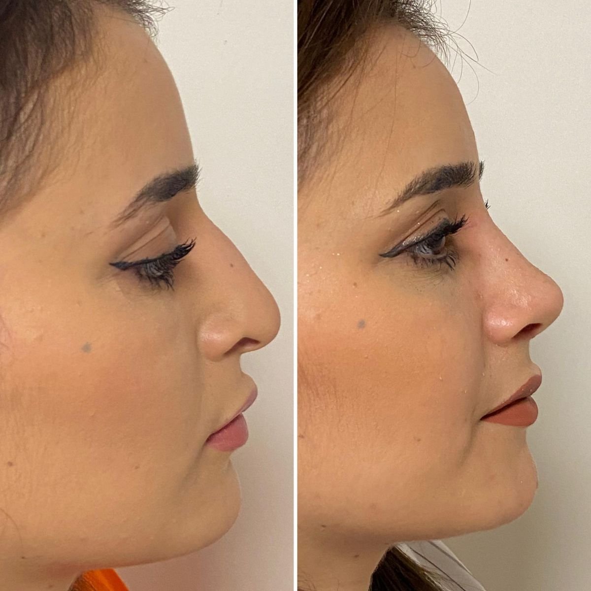 نتائج عملية تجميل الأنف قبل وبعد في Assoc.Prof.Dr.Cemal Kara / Medical Park İzmir Hospital