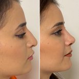 نتائج عملية تجميل الأنف قبل وبعد في Assoc.Prof.Dr.Cemal Kara / Medical Park İzmir Hospital